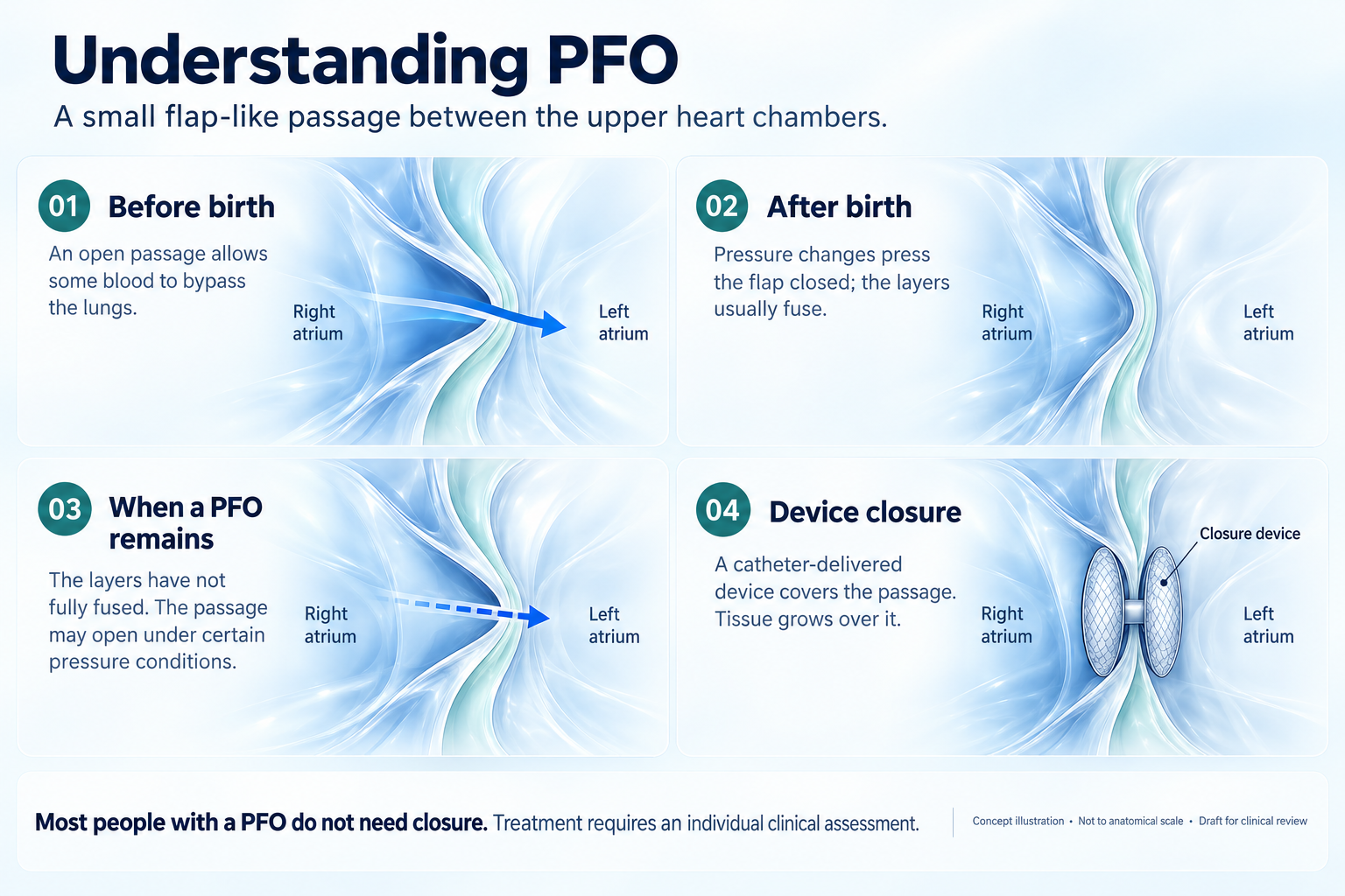Four-step concept illustration: a normal passage before birth, closure after birth, an unfused flap-like PFO passage, and a generic closure device covering that passage. Right and left atria are labelled.